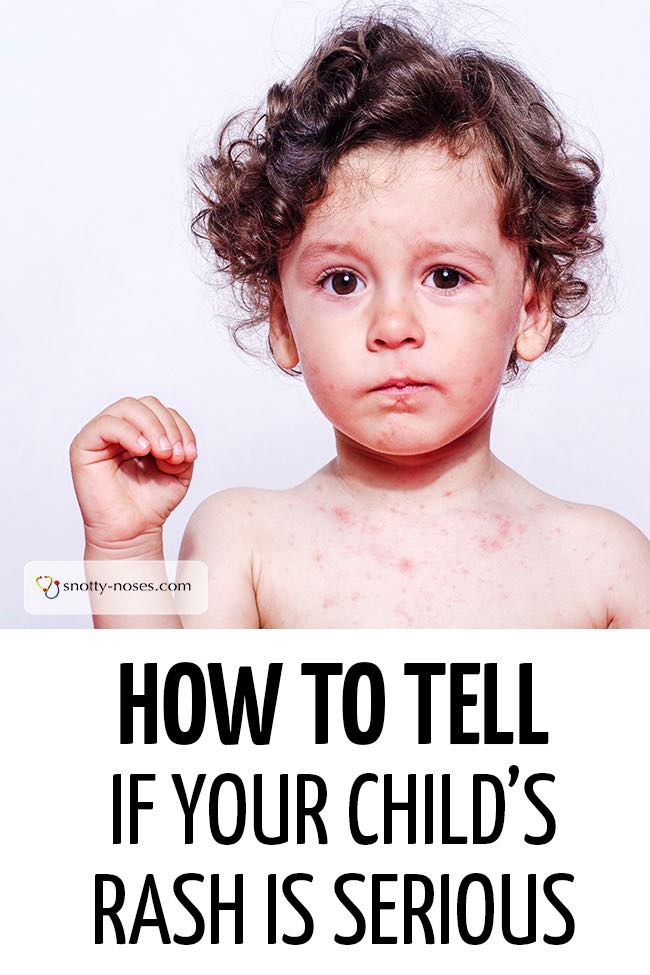 An unwell boy with a rash typical of a viral xanthoma. #childhealth #unwellchild #unwellkid #babyrash #childhoodrashes