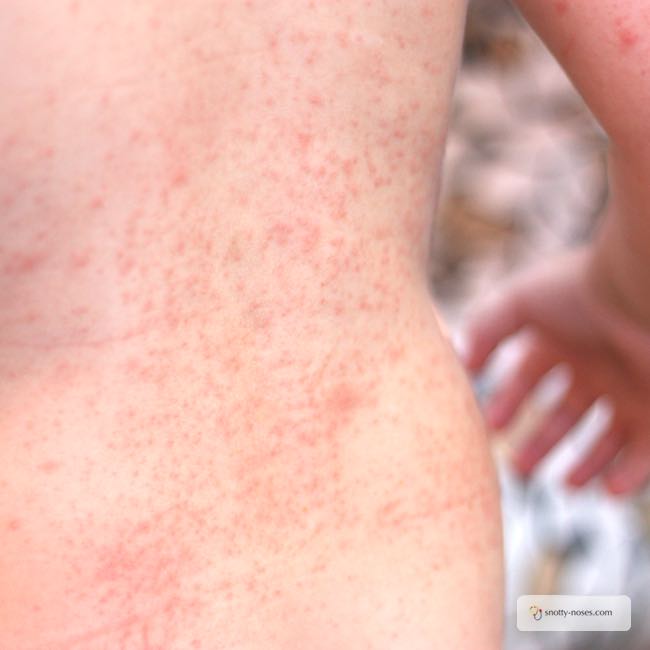 Prickly Heat Rash in Children by a pediatrician