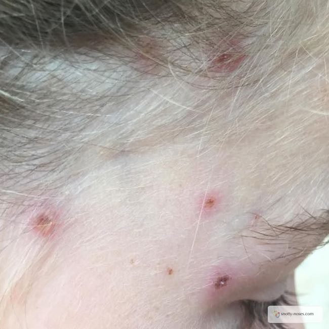 Chicken Pox in Children by Dr Orlena Kerek. A child's face with chicken pox scabs.