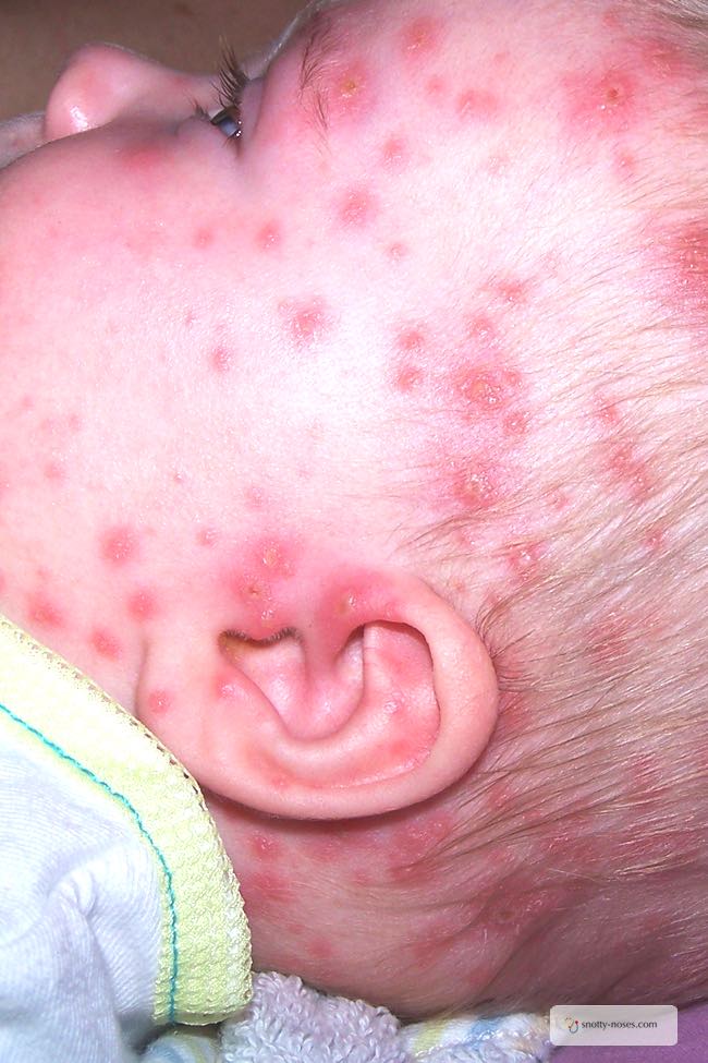 Chicken Pox in Babies by Dr Orlena Kerek. A baby's face with chicken pox rash. The rash has broken blisters but has not started to crust over yet.