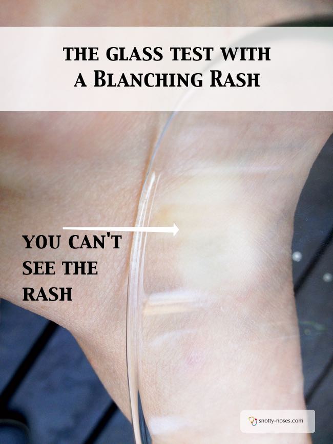 How can you tell if a rash is blanching or not? Do the glass test. A blanching rash disappears when you press a glass on it.