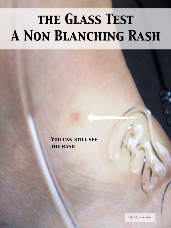 How can you tell if a rash is blanching or not? Do the glass Test. You can still see a blanching rash when you press a glass over it.