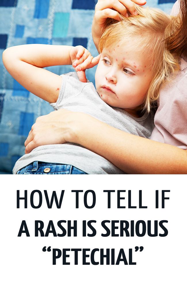 An unwell girl with a rash all over her, being held by her mother who isn't sure if the rash is serious or not. #childhealth #illchild #rashkids #rash #sickchild #parenting