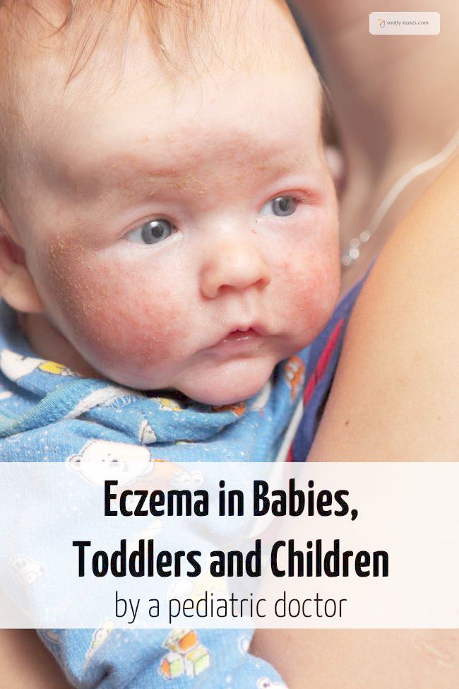 Eczema in babies, toddlers and children by a pediatric doctor