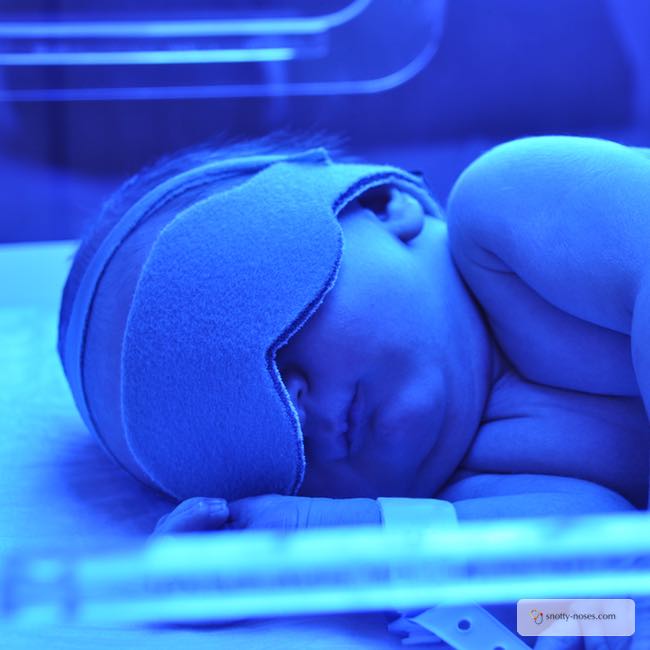 A newborn with neonatal jaundice receiving phototherapy