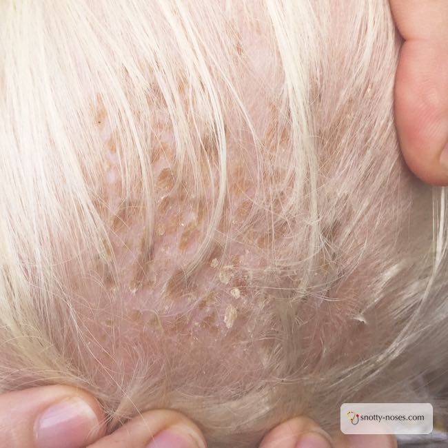 Cradle Cap (sebhorreic dermatitis) on a Baby's Scalp. A common complaint that normally resolves itself