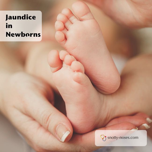 Jaundice in Newborns. What causes jaundice and why it is important